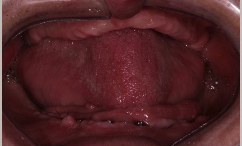 Boca do paciente antes do tratamento, com ausências dentárias