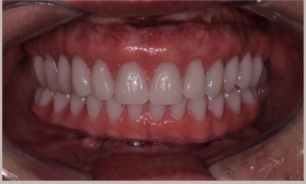 A mesma boca reabilitada com prótese sobre implantes